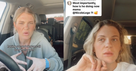 Mother’s Warning: Child Suffers Second-Degree Burns from Cup Noodles second-degree burns from Cup Noodles